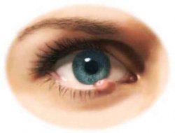 Ячмень. Лечение народными средствами