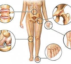 Лечение подагры