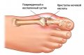 Подагра поможет от слабоумия