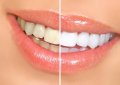 Отбеливание ZOOM и профилактическая чистка зубов: результаты работы