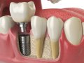 Виды зубной имплантации: выбираем, что челюсти угодно