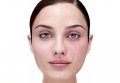 Демодекоз на лице — лечение лазером