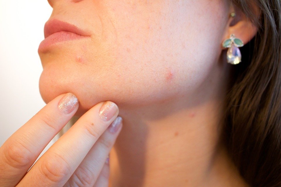 Сыпь на коже: причины, виды, заболевания (55 ФОТО)