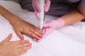 Грибок ногтей предлагают лечить с помощью лазера