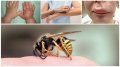 Как распознать и что делать при укусах насекомых (ФОТО)