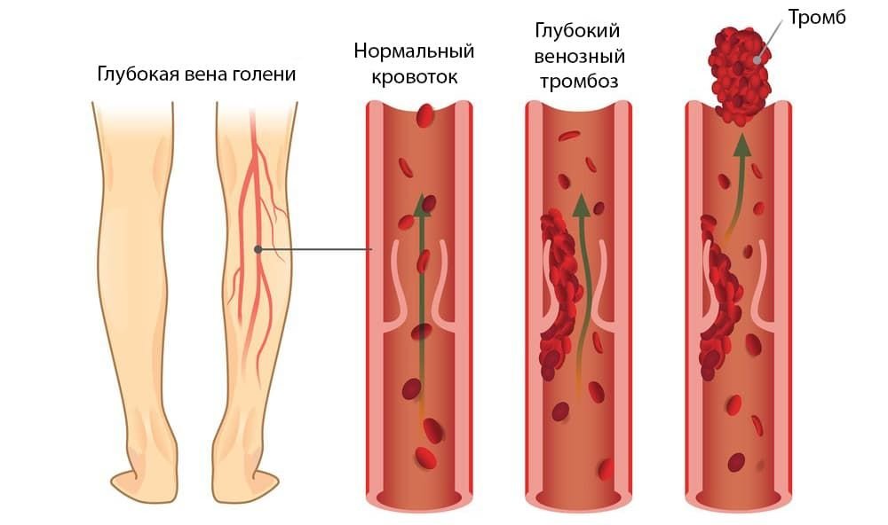 Как понять, что у вас тромбоз: симптомы и помощь - Medcentre.com.ua