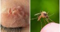 Комары заражают гельминтами: будьте осторожны