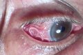 Из глаза мужчины вытащили 12-сантиметрового гельминта