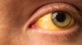 Желтые глаза у взрослого: что это может быть?