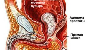 К раку простаты может привести витамин Е