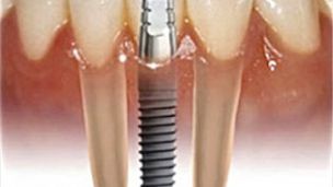 Имплантация зубов