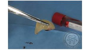 NEW!!! Костная пластика на основе мембран из собственной крови