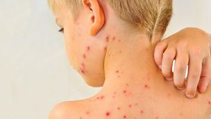 Корь: как распознать и когда вакцинировать ребенка