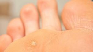 Бородавка: что это, почему возникает и в чём опасность