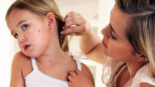 Почему в Украине вспыхнула корь? Отвечает врач-инфекционист