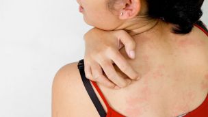 Висип на тілі: 56 видів висипів із причинами (ФОТО)