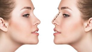 До 31 марта скидка 25% на операцию по изменению формы и размера носа