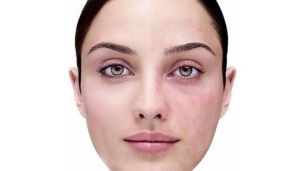 Демодекоз на лице — лечение лазером