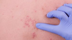 Как отличить корь от ветрянки, краснухи и других заболеваний