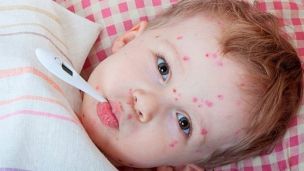 Ветрянка, корь, скарлатина и краснуха: в чем отличия? (ФОТО)