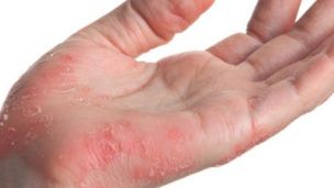 Чому псоріаз не можна лікувати гормонами?