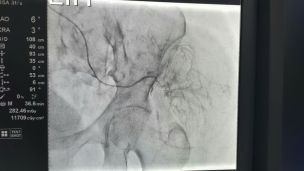 ІСТОРІЯ ОДНІЄЇ ЕМБОЛІЗАЦІЇ В TOMOCLINIC