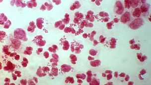 Поговоримо про уреаплазму.