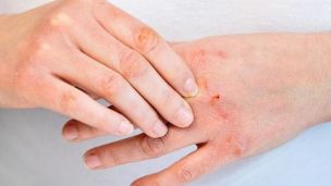 Відповідаємо на часті питання про псоріаз