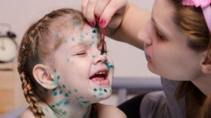 Доктор Комаровский: как лечить ветрянку