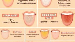 Налет на языке: цвет и возможные проблемы со здоровьем