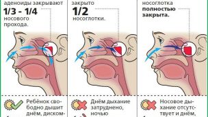Почему не нужно спешить удалять аденоиды ребенку