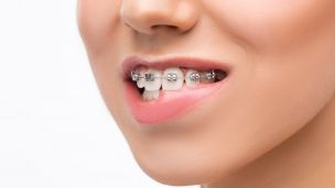 Що таке самолігуючі брекети?