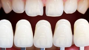 Вініри: навіщо вони потрібні і чи варто їх ставити?