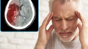 Безкоштовне лікування пацієнтів з інсультом