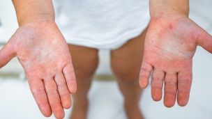 Скарлатина: симптоми, лікування, профілактика