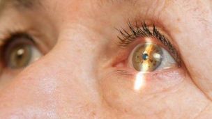 Катаракта: какие симптомы и как лечить