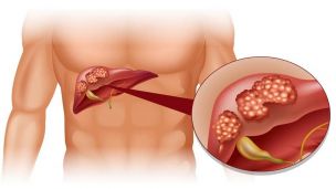 Полипы в желчном: причины и лечение