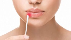 7 міфів про герпес