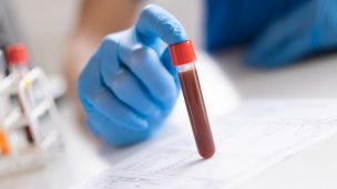 Що таке коагулограма і що показує цей аналіз