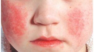 Парвовирусная инфекция: причины, симптомы, лечение