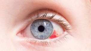 Чому може лопнути судина в оці?