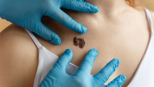 Першу в світі персоналізовану вакцину проти раку шкіри створили у Великобританії