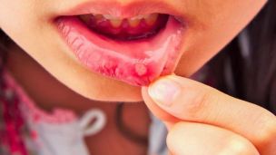 Чим лікувати стоматит: аптечні і народні засоби