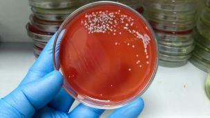 «М’ясоїдна бактерія»: світом шириться смертельна хвороба