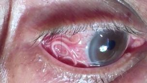 З ока чоловіка витягнули 12-сантиметрового гельмінта