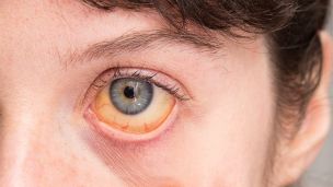 Спалах вірусного гепатиту А на Прикарпатті