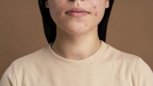 Демодекоз: причини, симптоми, лікування