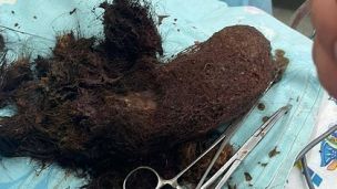 Килограмм волос в желудке: девушку спасли львовские врачи