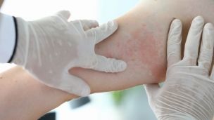 Как понять, что у вас аллергия на алкоголь