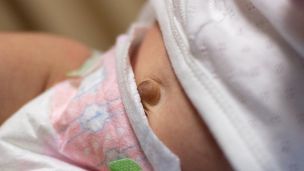 Пупочная грыжа у детей: что нужно знать родителям